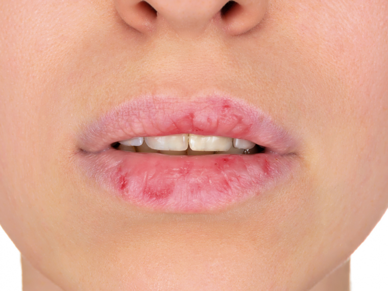 Punca Bibir Kering Dan Mengelupas